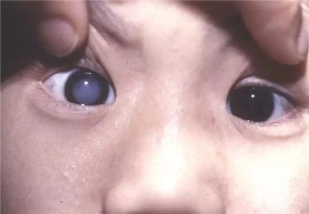 北京,希玛,眼科,“,小儿,白内障,复明,由于, 北京,希玛,眼科,“,小儿,白内障,复明,由于,