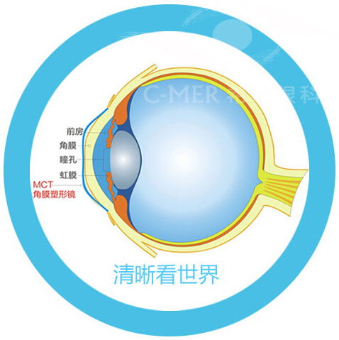 专家,解析,什么,是,角膜,塑形,镜,什么,是, 专家,解析,什么,是,角膜,塑形,镜,什么,是,