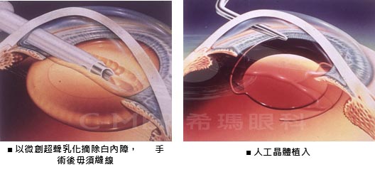 希玛,医生,重点,讲解,引起,白内障,的, 希玛,医生,重点,讲解,引起,白内障,的,