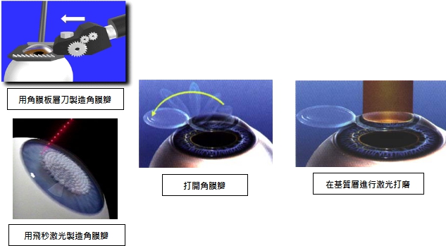 超,高度,近视,屈光,不正,的,病因,有,哪些, 超,高度,近视,屈光,不正,的,病因,有,哪些,