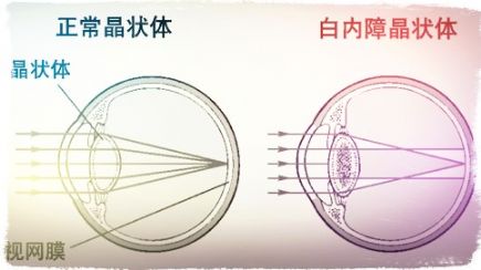 不,要等,白内障,成熟,时,才,做,手术,白内障, 不,要等,白内障,成熟,时,才,做,手术,白内障,