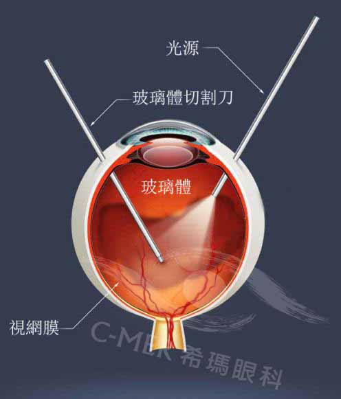 治疗,飞蚊,症选,希玛,体验,正规,医院,飞蚊,症, 治疗,飞蚊,症选,希玛,体验,正规,医院,飞蚊,症,