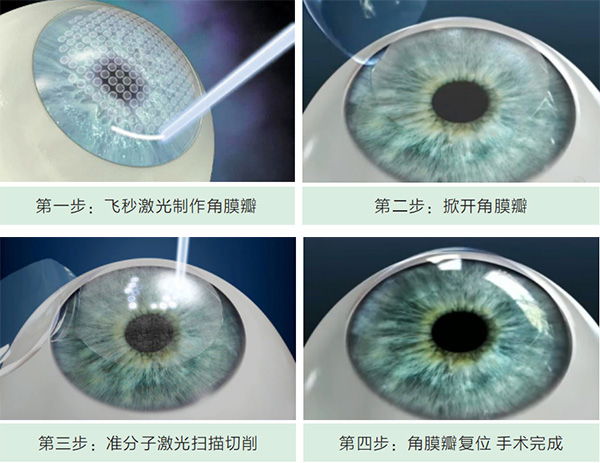 近视治疗,飞秒,激光,无刀,手术,更,精细,、, 近视治疗,飞秒,激光,无刀,手术,更,精细,、,